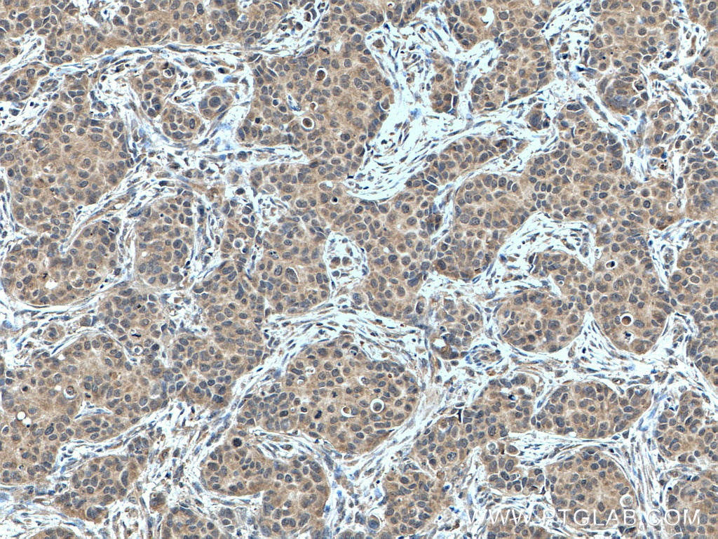 Immunohistochemistry (IHC) staining of human breast cancer tissue using NBR1 Polyclonal antibody (16004-1-AP)