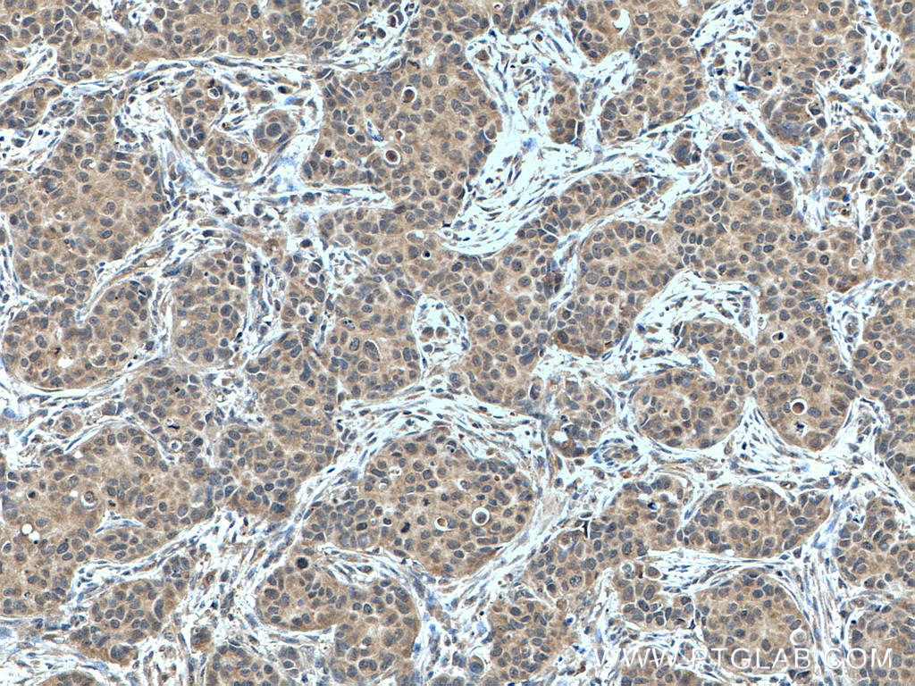 IHC staining of human breast cancer using 16004-1-AP