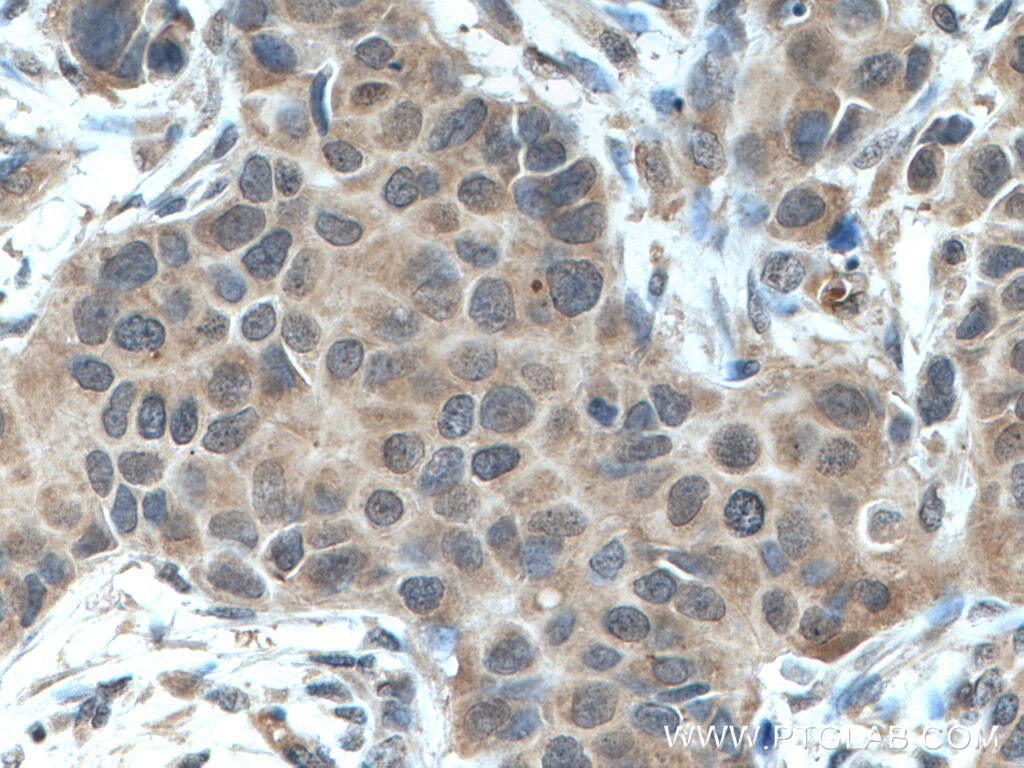 Immunohistochemistry (IHC) staining of human breast cancer tissue using NBR1 Polyclonal antibody (16004-1-AP)