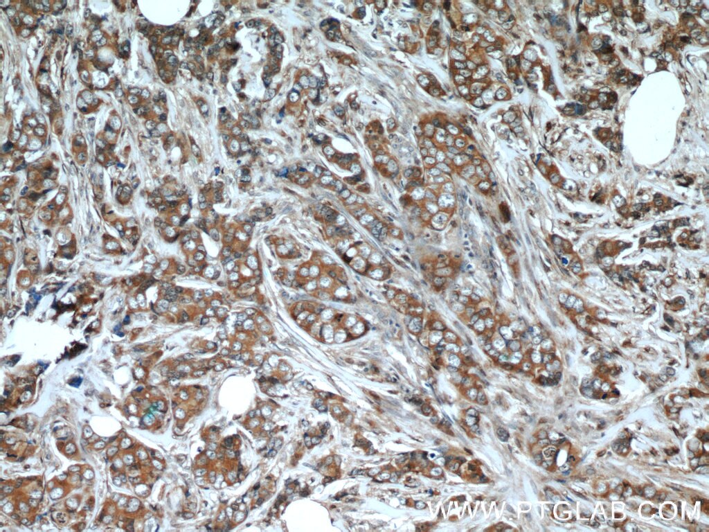 IHC staining of human breast cancer using 16004-1-AP