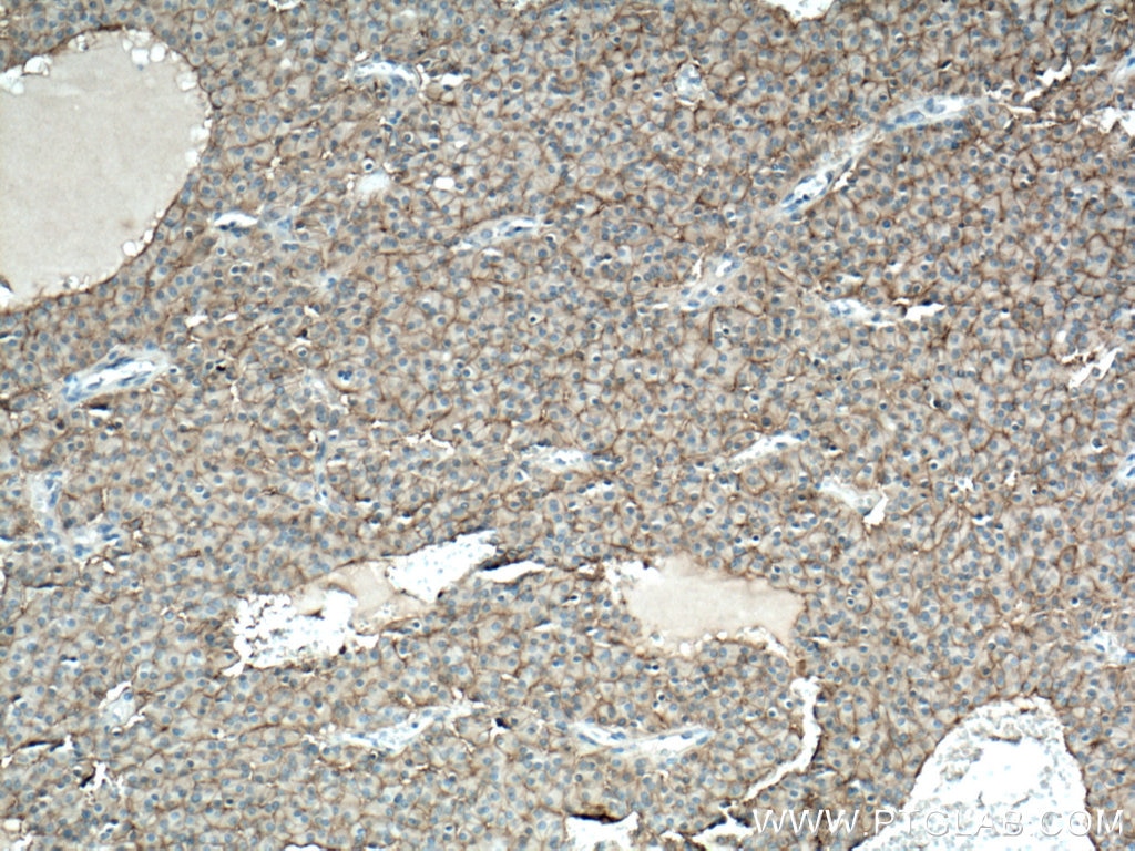 Immunohistochemistry (IHC) staining of Insulinoma tissue using NCAM1/CD56 Polyclonal antibody (14255-1-AP)