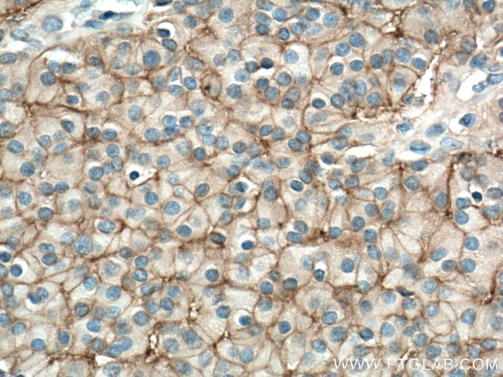Immunohistochemistry (IHC) staining of Insulinoma tissue using NCAM1/CD56 Polyclonal antibody (14255-1-AP)