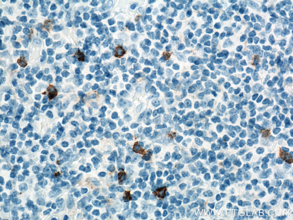 Immunohistochemistry (IHC) staining of human tonsillitis tissue using NCAM1/CD56 Polyclonal antibody (14255-1-AP)
