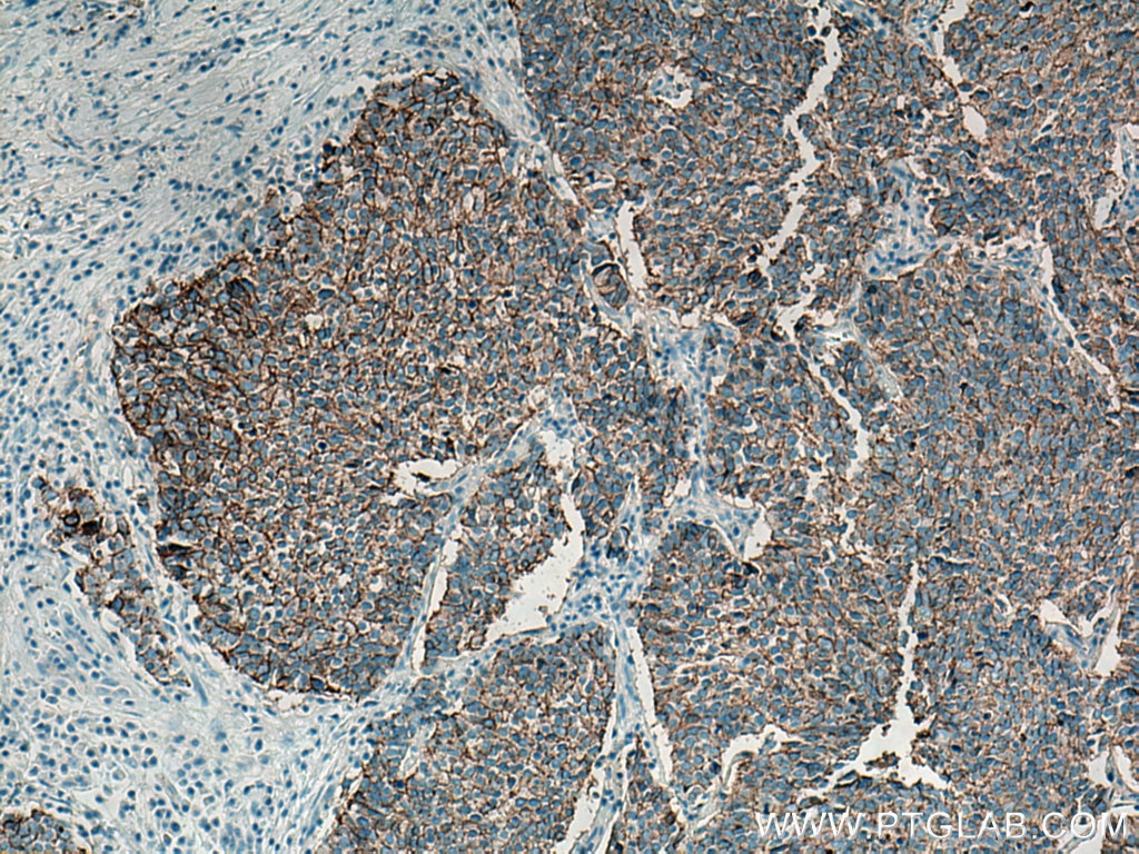 Immunohistochemistry (IHC) staining of human lung cancer tissue using NCAM1/CD56 Polyclonal antibody (14255-1-AP)