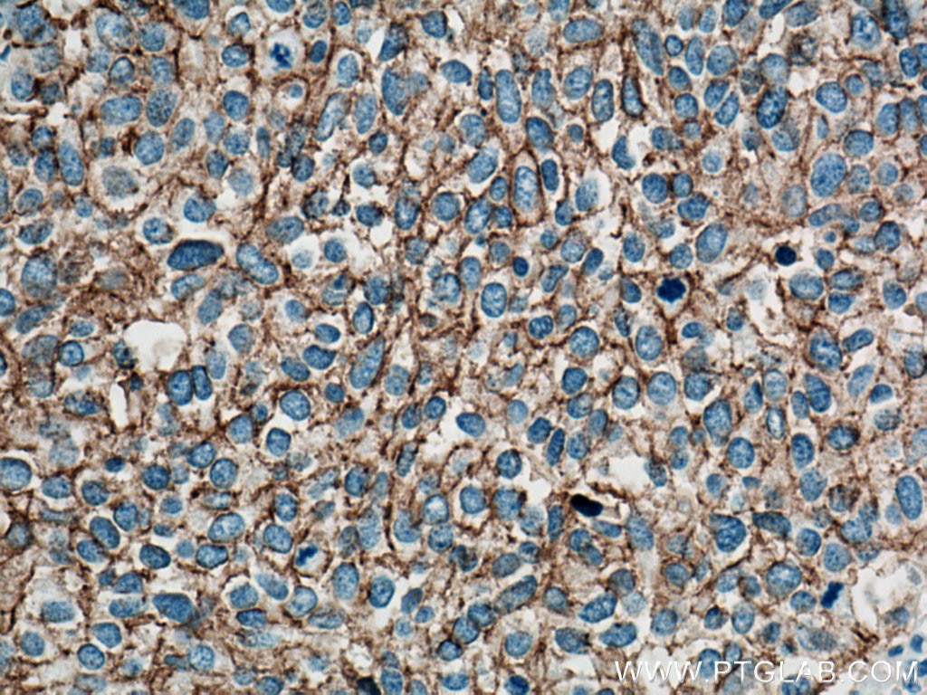 Immunohistochemistry (IHC) staining of human lung cancer tissue using NCAM1/CD56 Polyclonal antibody (14255-1-AP)