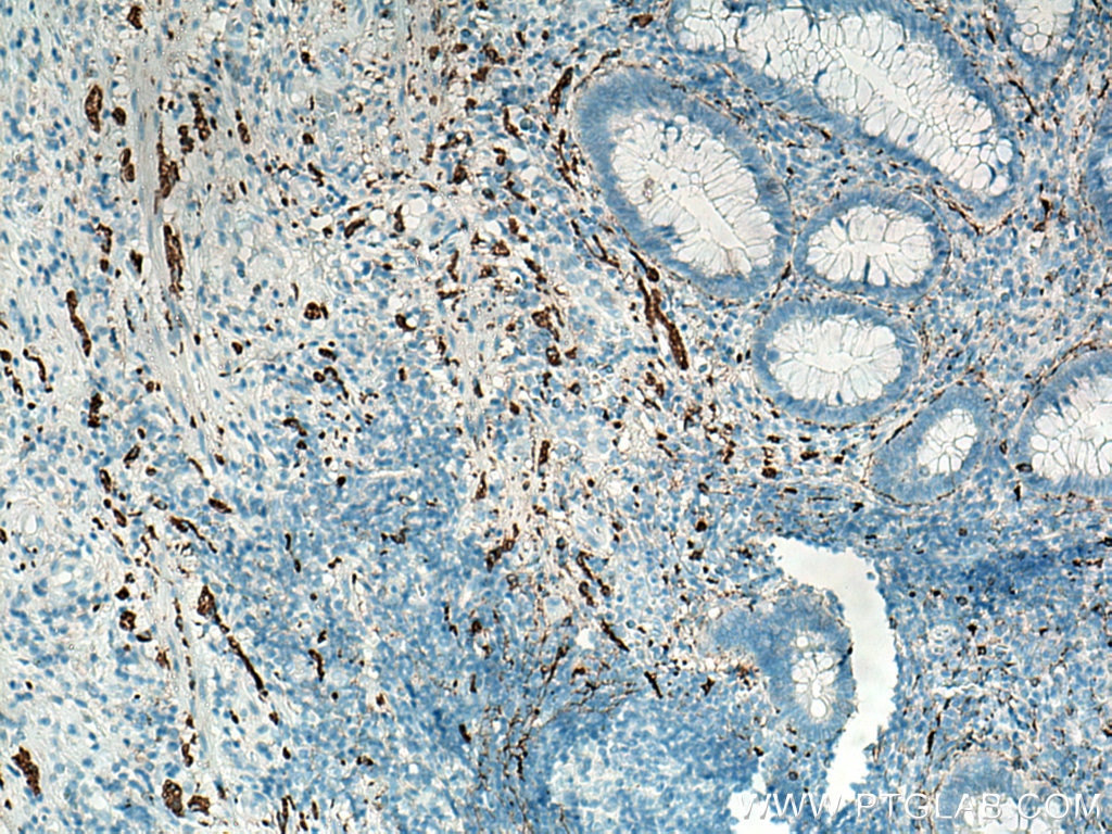 Immunohistochemistry (IHC) staining of human appendicitis tissue using NCAM1/CD56 Polyclonal antibody (14255-1-AP)