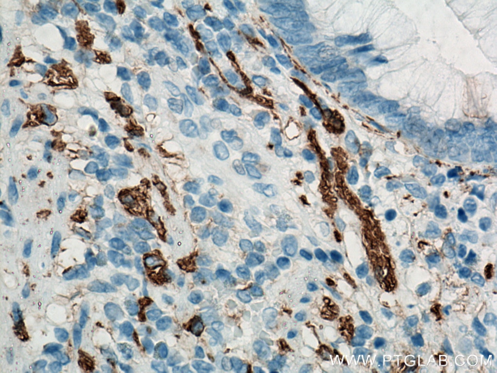 Immunohistochemistry (IHC) staining of human appendicitis tissue using NCAM1/CD56 Polyclonal antibody (14255-1-AP)