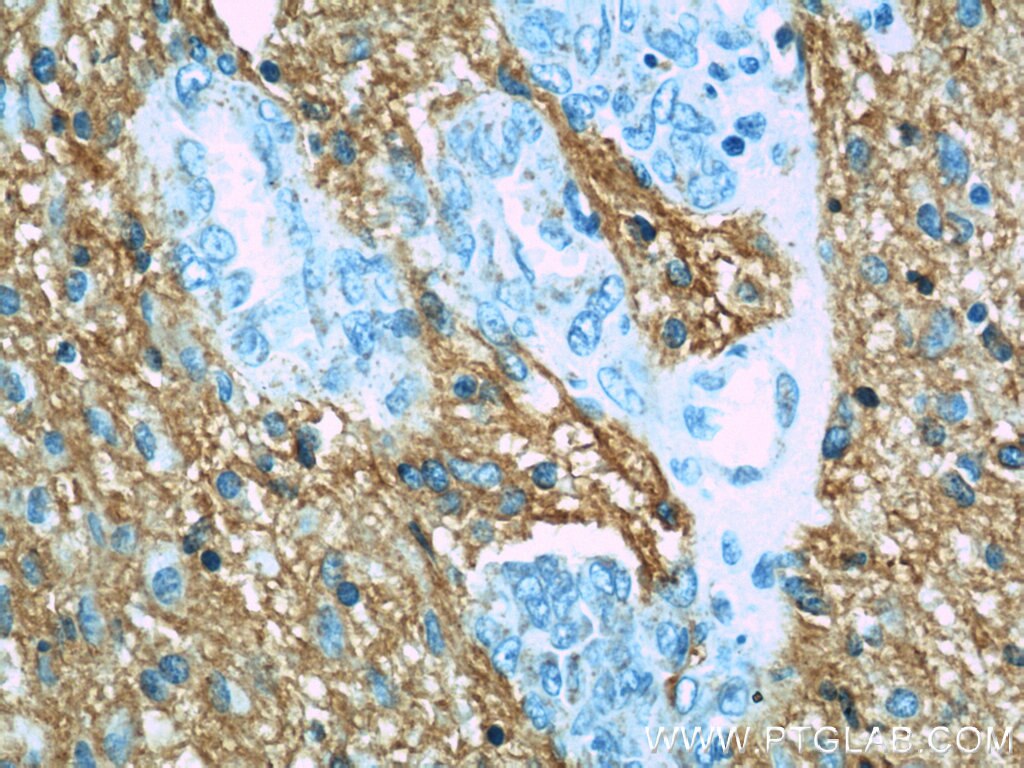 Immunohistochemistry (IHC) staining of human gliomas tissue using NCAM1/CD56 Polyclonal antibody (14255-1-AP)