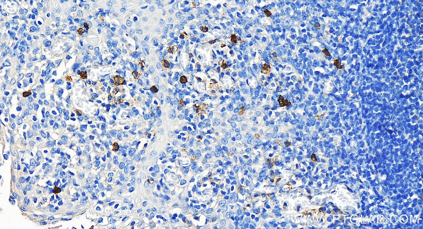 Immunohistochemistry (IHC) staining of human tonsillitis tissue using NCAM1/CD56 Polyclonal antibody (14255-1-AP)