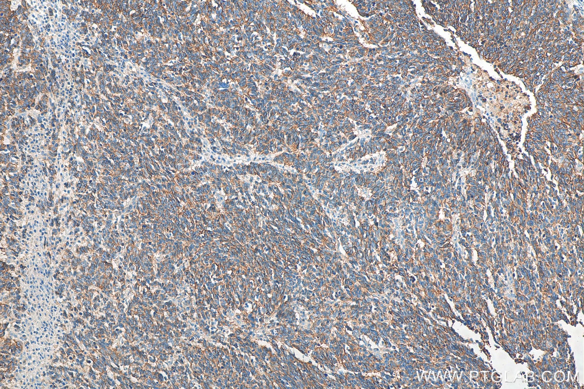 Immunohistochemistry (IHC) staining of human lung cancer tissue using NCAM1/CD56 Monoclonal antibody (60238-1-Ig)