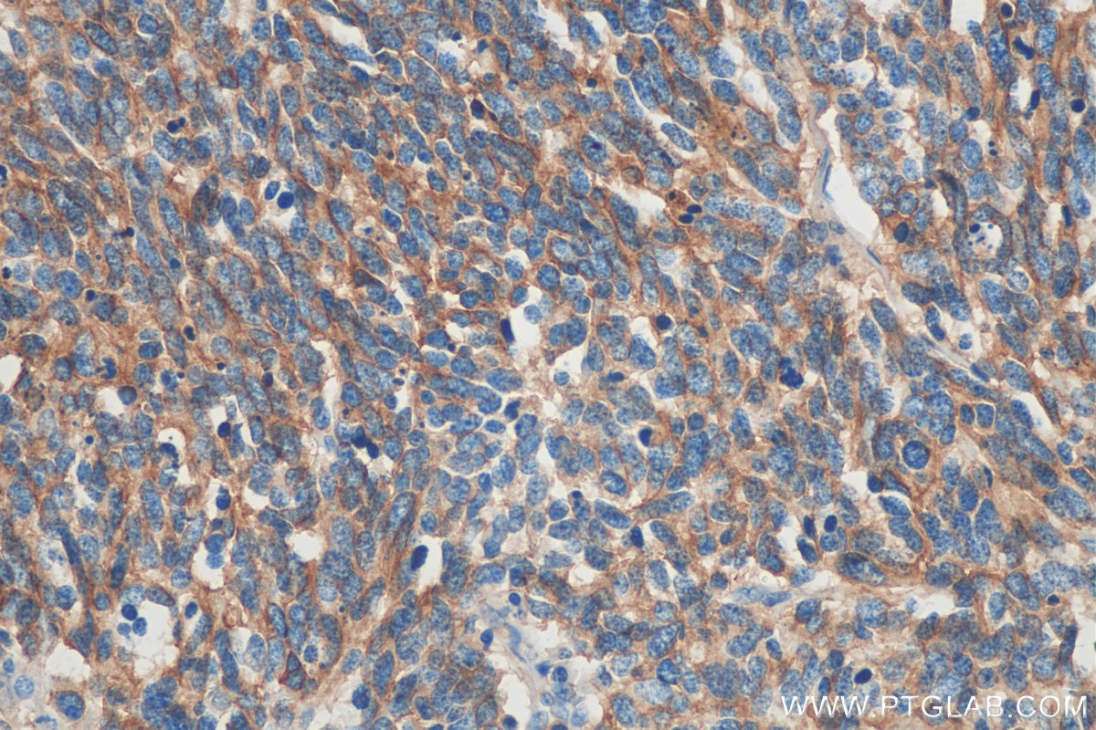 Immunohistochemistry (IHC) staining of human lung cancer tissue using NCAM1/CD56 Monoclonal antibody (60238-1-Ig)