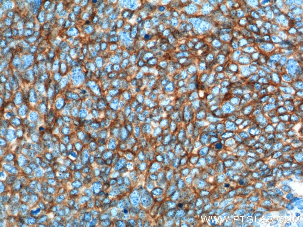 IHC staining of human lung cancer using 60238-1-Ig