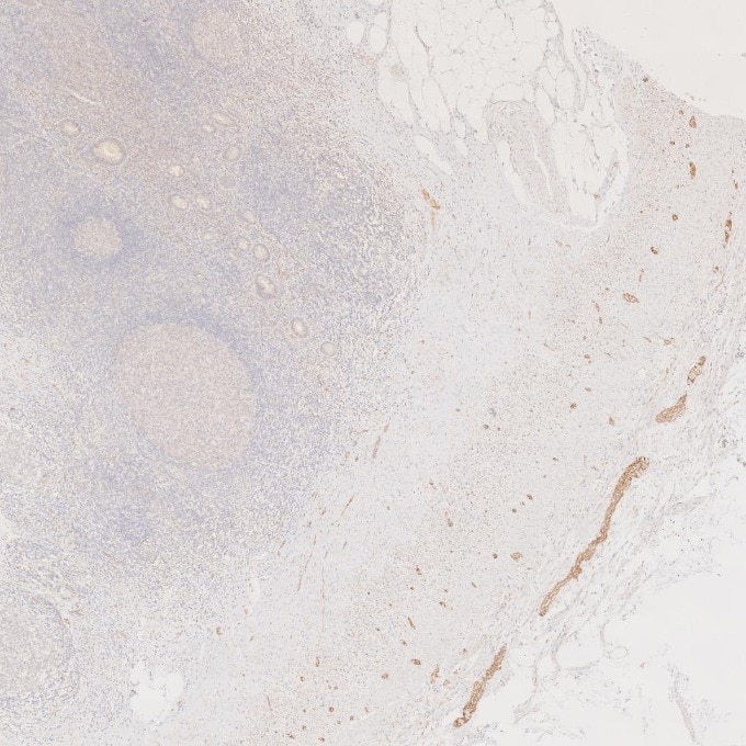 IHC staining of human appendicitis using 60238-1-Ig Immunohistochemistry (IHC) staining of human appendicitis tissue using NCAM1/CD56 Monoclonal antibody (60238-1-Ig)