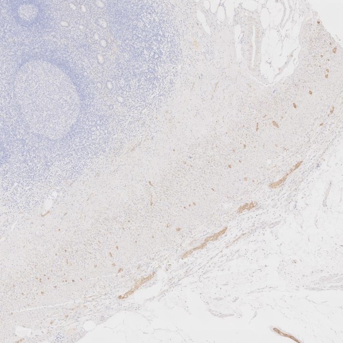 IHC staining of human appendicitis using 60238-1-Ig Immunohistochemistry (IHC) staining of human appendicitis tissue using NCAM1/CD56 Monoclonal antibody (60238-1-Ig)