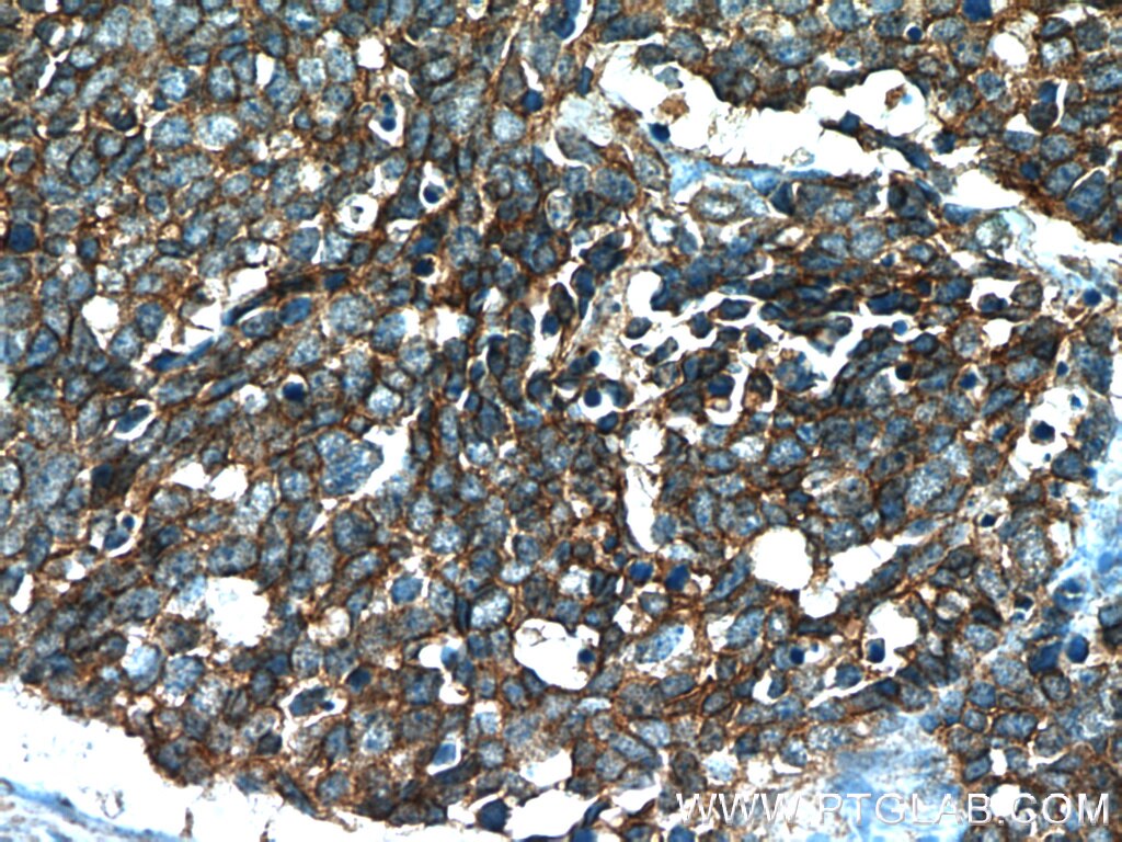 IHC staining of human lung cancer using 60238-1-Ig