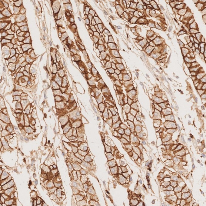 IHC staining of human stomach cancer using 82715-1-RR Immunohistochemistry (IHC) staining of human stomach cancer tissue using NCAM1/CD56 Recombinant monoclonal antibody (82715-1-RR)