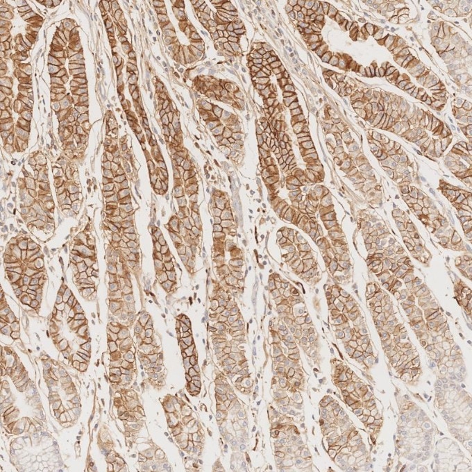 IHC staining of human stomach cancer using 82715-1-RR Immunohistochemistry (IHC) staining of human stomach cancer tissue using NCAM1/CD56 Recombinant monoclonal antibody (82715-1-RR)