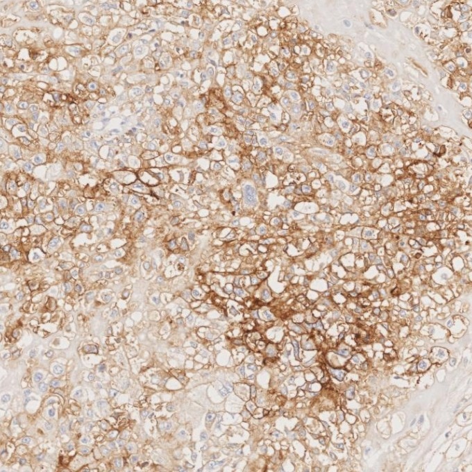 IHC staining of human stomach cancer using 82715-1-RR Immunohistochemistry (IHC) staining of human stomach cancer tissue using NCAM1/CD56 Recombinant monoclonal antibody (82715-1-RR)