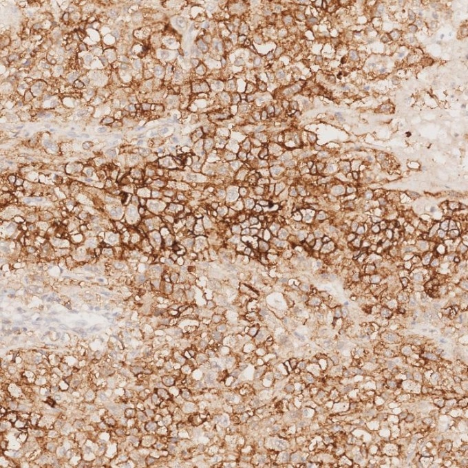 IHC staining of human stomach cancer using 82715-1-RR Immunohistochemistry (IHC) staining of human stomach cancer tissue using NCAM1/CD56 Recombinant monoclonal antibody (82715-1-RR)
