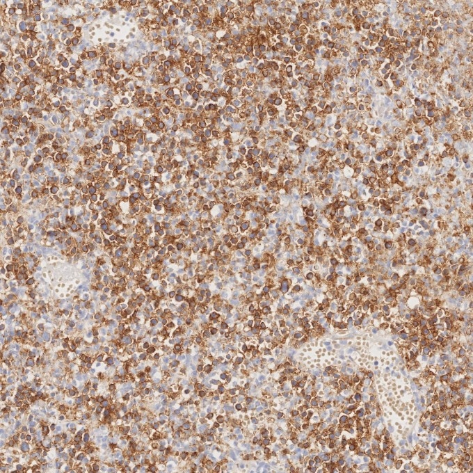 IHC staining of human lymphoma using 82715-1-RR Immunohistochemistry (IHC) staining of human lymphoma tissue using NCAM1/CD56 Recombinant monoclonal antibody (82715-1-RR)