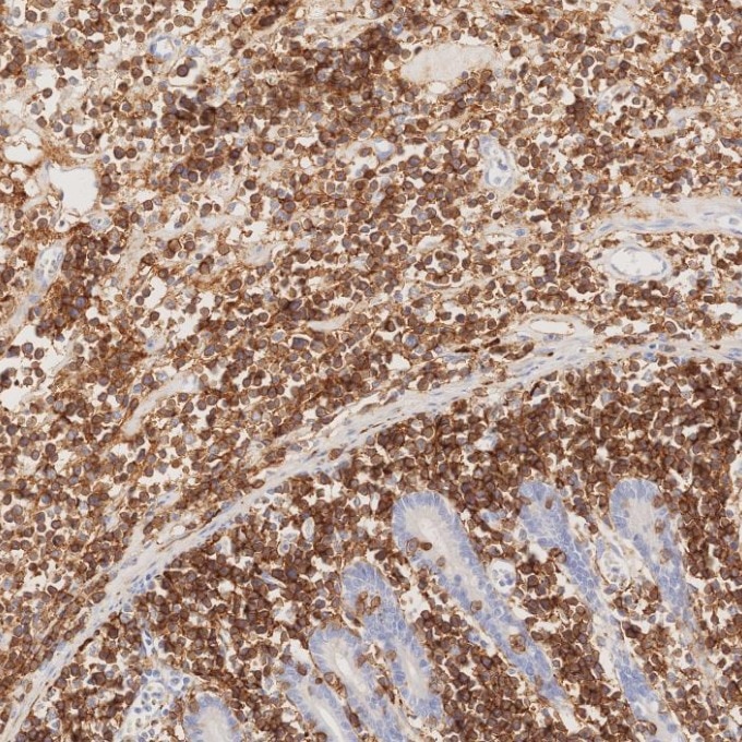 IHC staining of human lymphoma using 82715-1-RR Immunohistochemistry (IHC) staining of human lymphoma tissue using NCAM1/CD56 Recombinant monoclonal antibody (82715-1-RR)