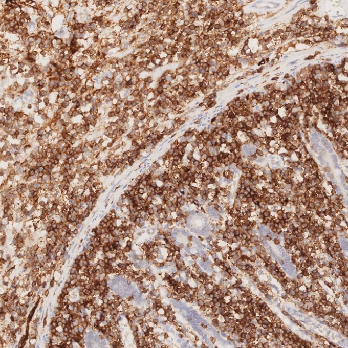 IHC staining of human lymphoma using 82715-1-RR Immunohistochemistry (IHC) staining of human lymphoma tissue using NCAM1/CD56 Recombinant monoclonal antibody (82715-1-RR)