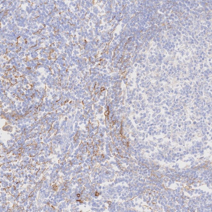IHC staining of human tonsillitis using 82715-1-RR Immunohistochemistry (IHC) staining of human tonsillitis tissue using NCAM1/CD56 Recombinant monoclonal antibody (82715-1-RR)