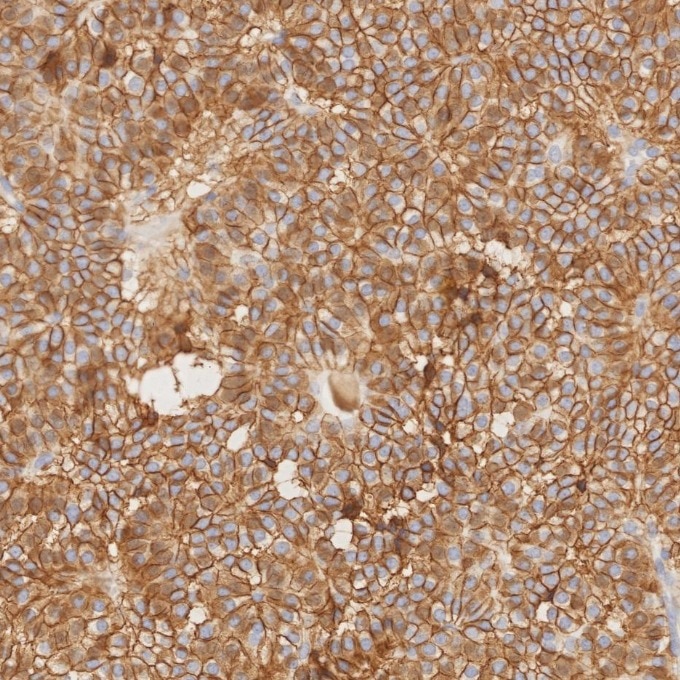 IHC staining of human pituitary adenoma using 82715-1-RR Immunohistochemistry (IHC) staining of human pituitary adenoma tissue using NCAM1/CD56 Recombinant monoclonal antibody (82715-1-RR)