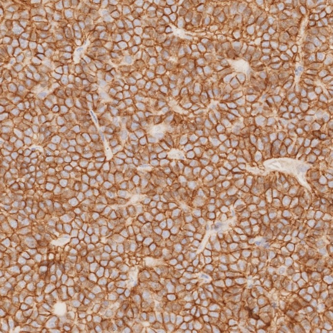 IHC staining of human pituitary adenoma using 82715-1-RR Immunohistochemistry (IHC) staining of human pituitary adenoma tissue using NCAM1/CD56 Recombinant monoclonal antibody (82715-1-RR)