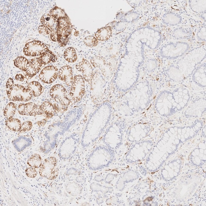 IHC staining of human stomach cancer using 82715-3-RR Immunohistochemistry (IHC) staining of human stomach cancer tissue using NCAM1/CD56 Recombinant monoclonal antibody (82715-3-RR)