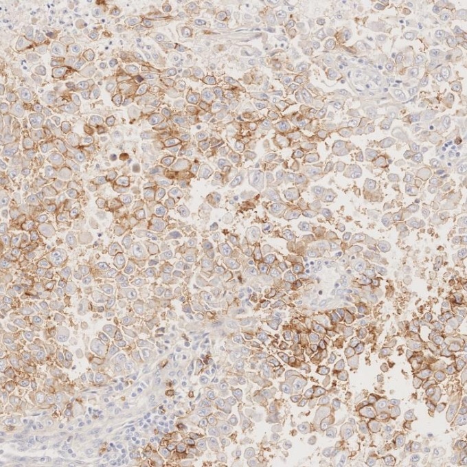 IHC staining of human stomach cancer using 82715-3-RR Immunohistochemistry (IHC) staining of human stomach cancer tissue using NCAM1/CD56 Recombinant monoclonal antibody (82715-3-RR)