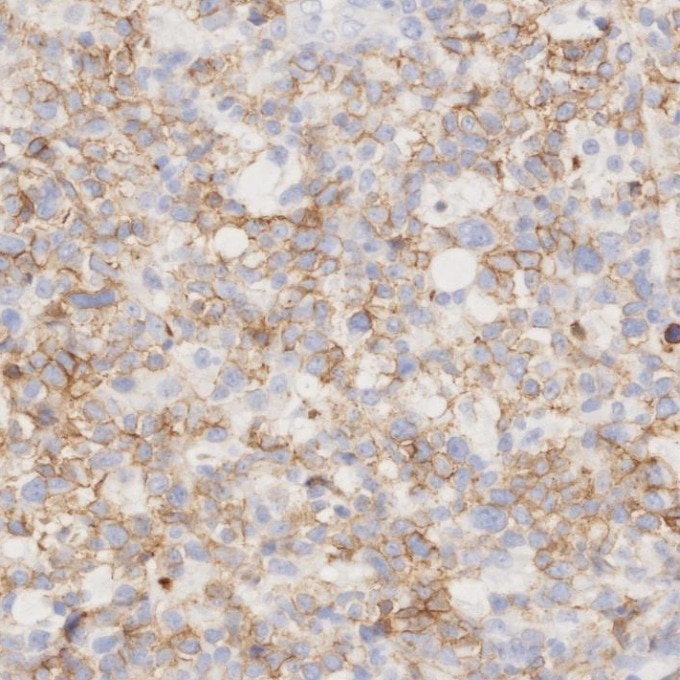 IHC staining of human lymphoma using 82715-3-RR Immunohistochemistry (IHC) staining of human lymphoma tissue using NCAM1/CD56 Recombinant monoclonal antibody (82715-3-RR)