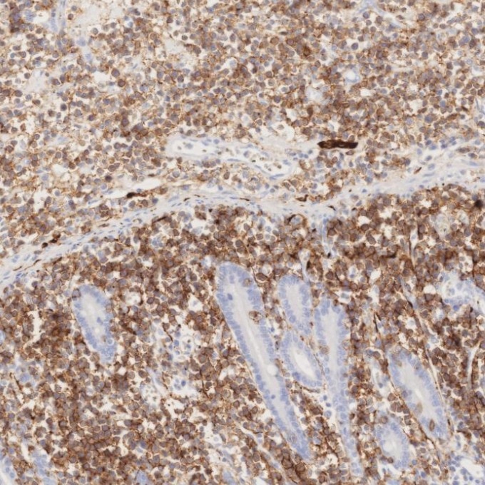 IHC staining of human lymphoma using 82715-3-RR Immunohistochemistry (IHC) staining of human lymphoma tissue using NCAM1/CD56 Recombinant monoclonal antibody (82715-3-RR)