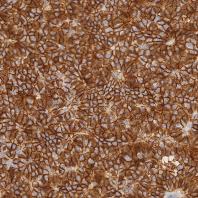 IHC staining of human pituitary adenoma using 82715-3-RR Immunohistochemistry (IHC) staining of human pituitary adenoma tissue using NCAM1/CD56 Recombinant monoclonal antibody (82715-3-RR)