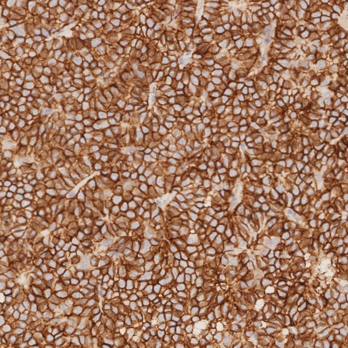 IHC staining of human pituitary adenoma using 82715-3-RR Immunohistochemistry (IHC) staining of human pituitary adenoma tissue using NCAM1/CD56 Recombinant monoclonal antibody (82715-3-RR)