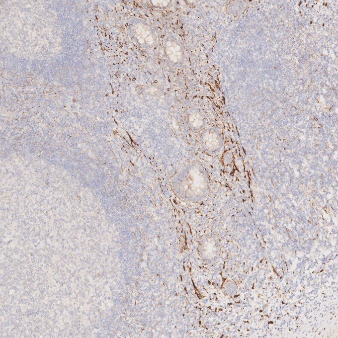 IHC staining of human appendicitis using 82715-3-RR Immunohistochemistry (IHC) staining of human appendicitis tissue using NCAM1/CD56 Recombinant monoclonal antibody (82715-3-RR)