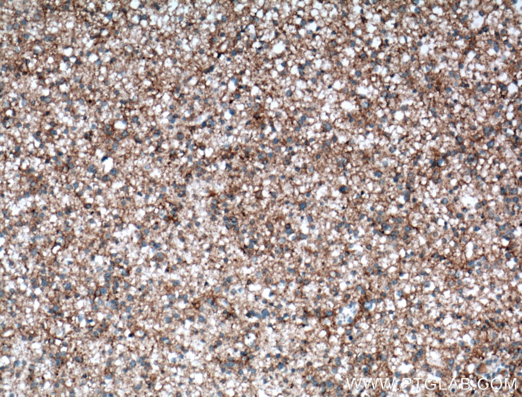 Immunohistochemistry (IHC) staining of human gliomas tissue using NCAM2 Polyclonal antibody (13850-1-AP)