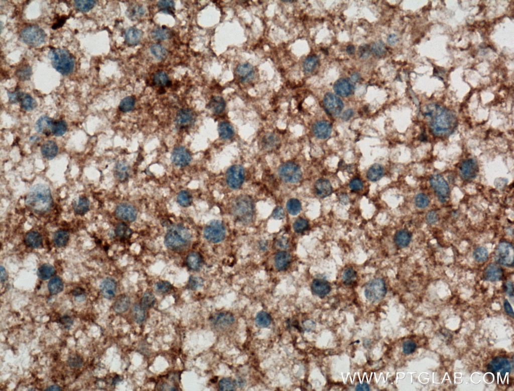 IHC staining of human gliomas using 13850-1-AP