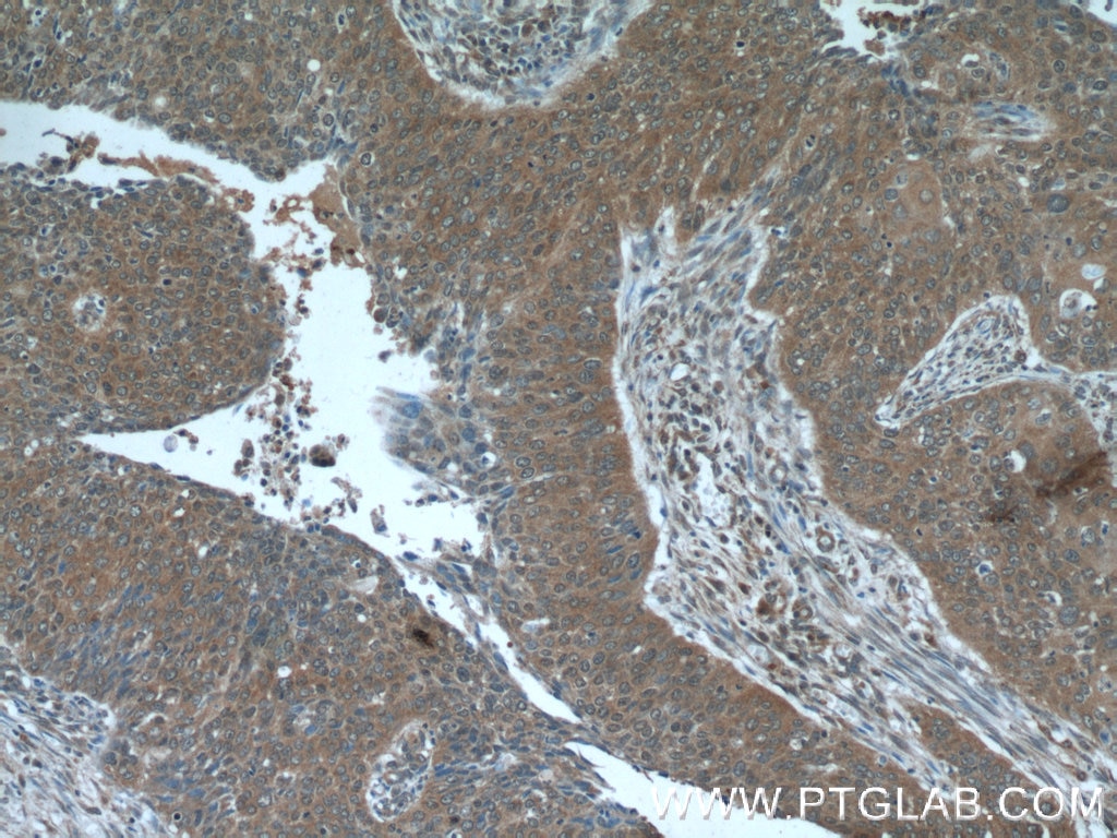 Immunohistochemistry (IHC) staining of human cervical cancer tissue using NCAPG Polyclonal antibody (24563-1-AP)