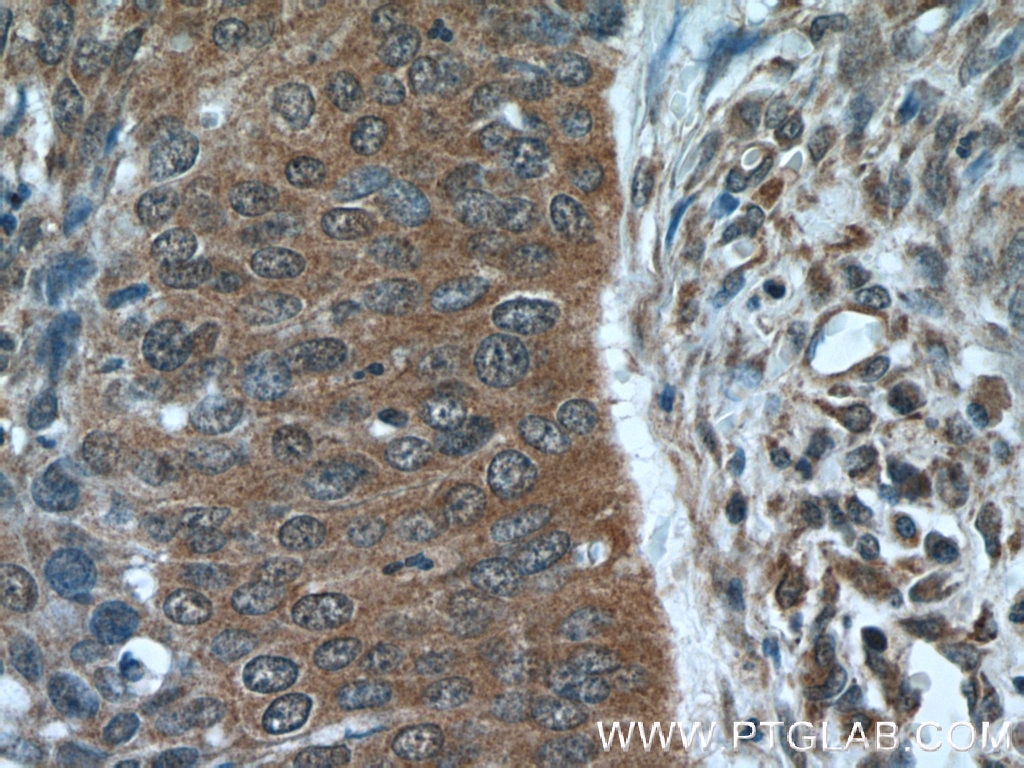 Immunohistochemistry (IHC) staining of human cervical cancer tissue using NCAPG Polyclonal antibody (24563-1-AP)