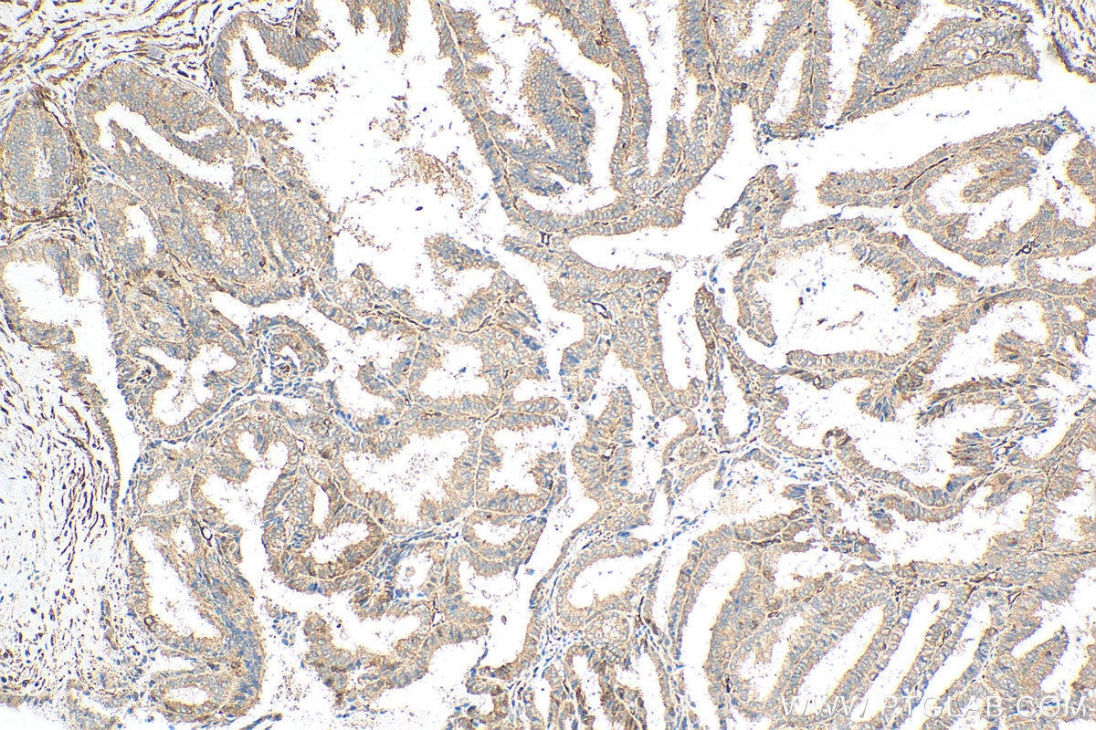 IHC staining of human ovary tumor using 29933-1-AP