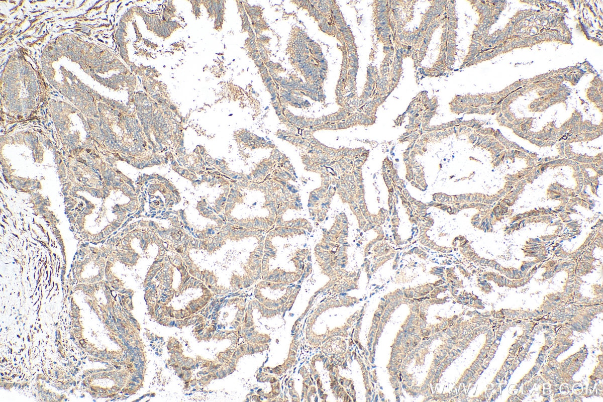 Immunohistochemistry (IHC) staining of human ovary tumor tissue using NCAPG Polyclonal antibody (29933-1-AP)