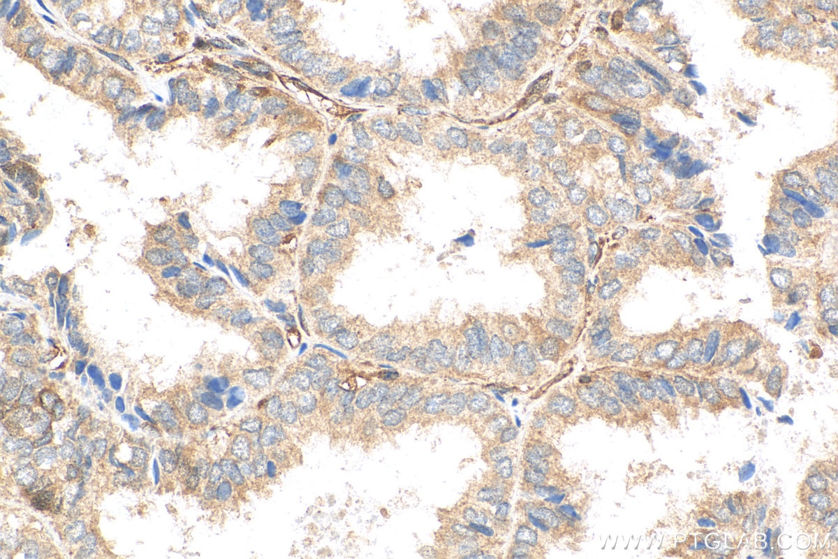 Immunohistochemistry (IHC) staining of human ovary tumor tissue using NCAPG Polyclonal antibody (29933-1-AP)