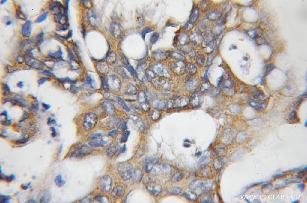 IHC staining of human colon cancer using 11515-1-AP