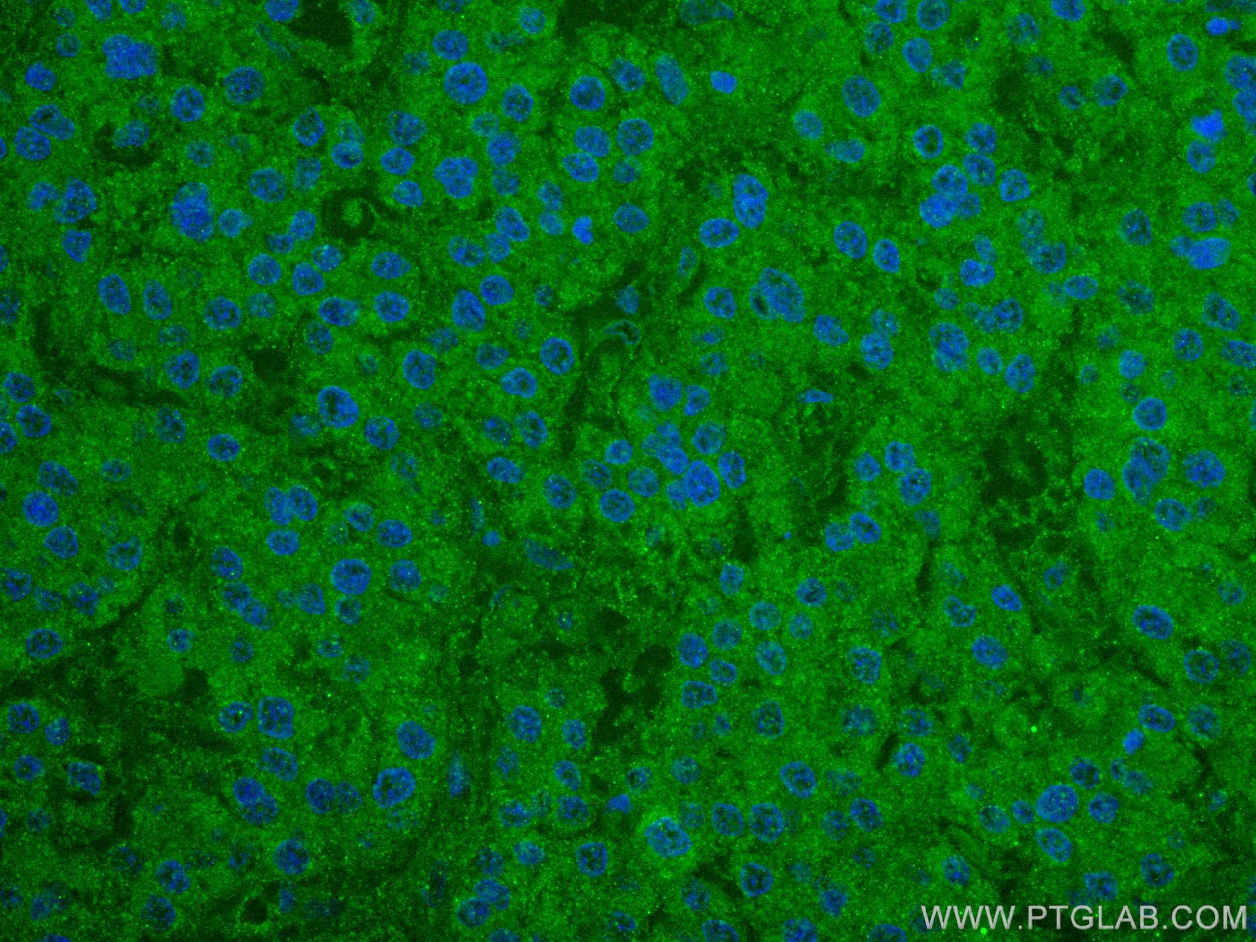 Immunofluorescence (IF) / fluorescent staining of human liver cancer tissue using NCAPH Monoclonal antibody (67655-1-Ig)
