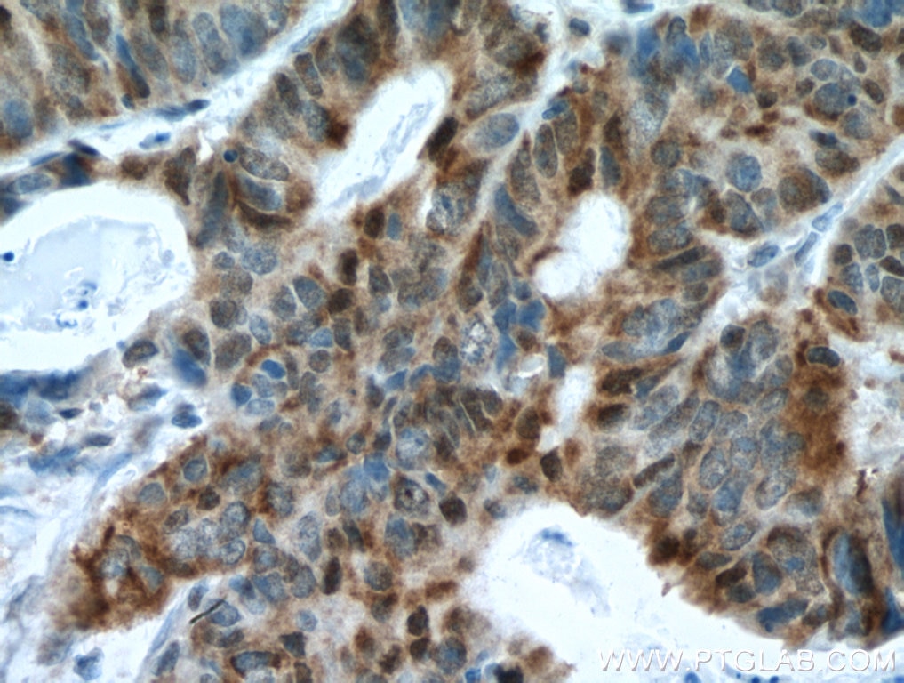 Immunohistochemistry (IHC) staining of human colon cancer tissue using NCAPH Monoclonal antibody (67655-1-Ig)
