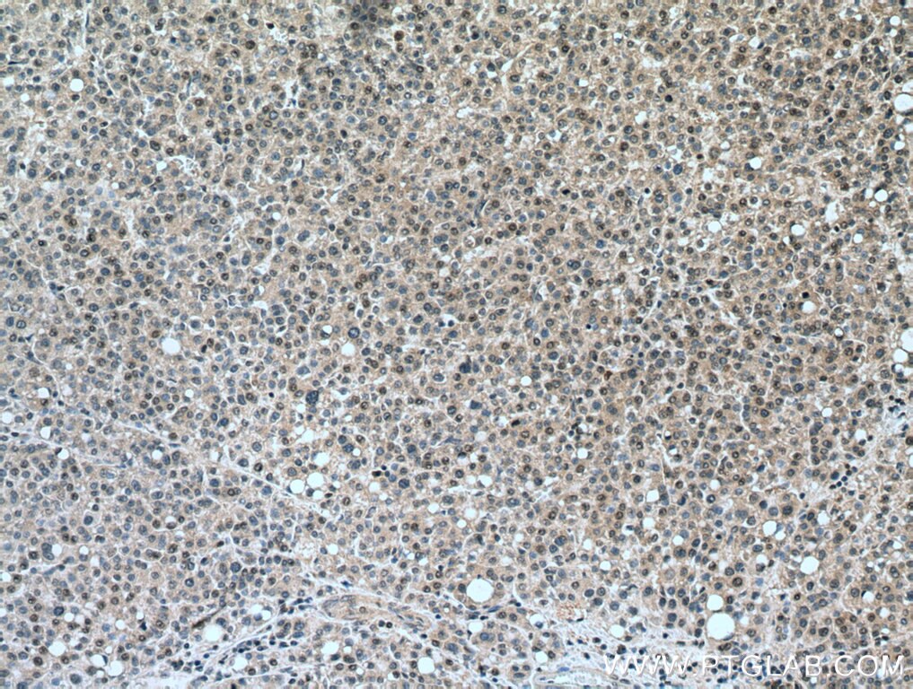 Immunohistochemistry (IHC) staining of human liver cancer tissue using NCAPH Monoclonal antibody (67655-1-Ig)