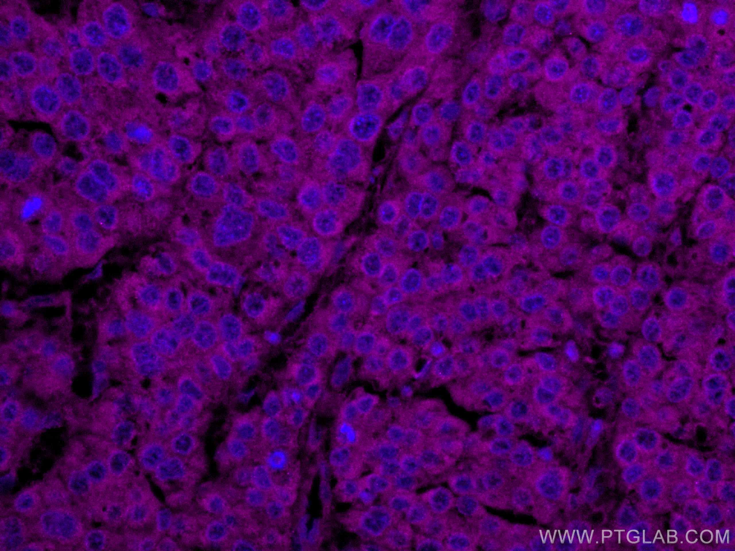 Immunofluorescence (IF) / fluorescent staining of human liver cancer tissue using CoraLite® Plus 647-conjugated NCAPH Monoclonal ant (CL647-67655)