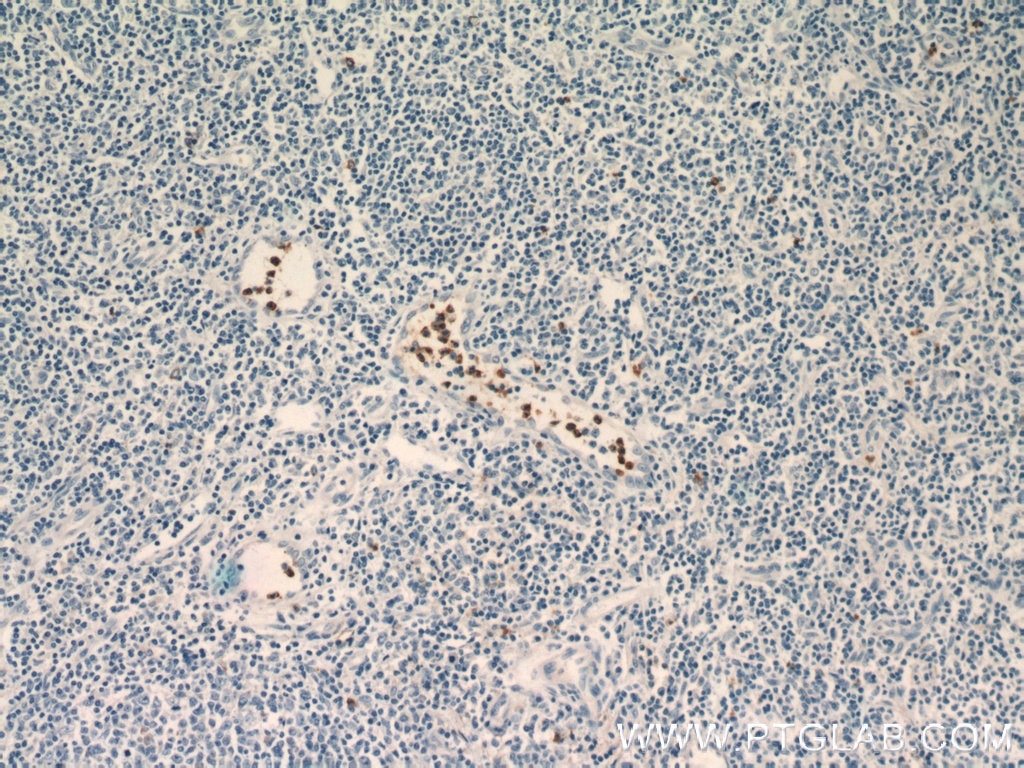 Immunohistochemistry (IHC) staining of human tonsillitis tissue using NOXA2/p67phox Polyclonal antibody (15551-1-AP)
