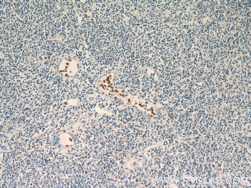 IHC staining of human tonsillitis using 15551-1-AP